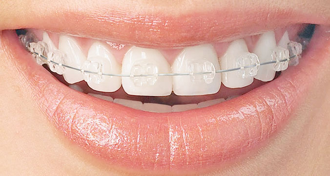 Зубы с сапфировыми брекетами
